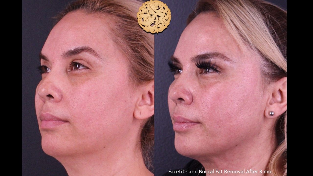Buccal Fat Removal Before & After