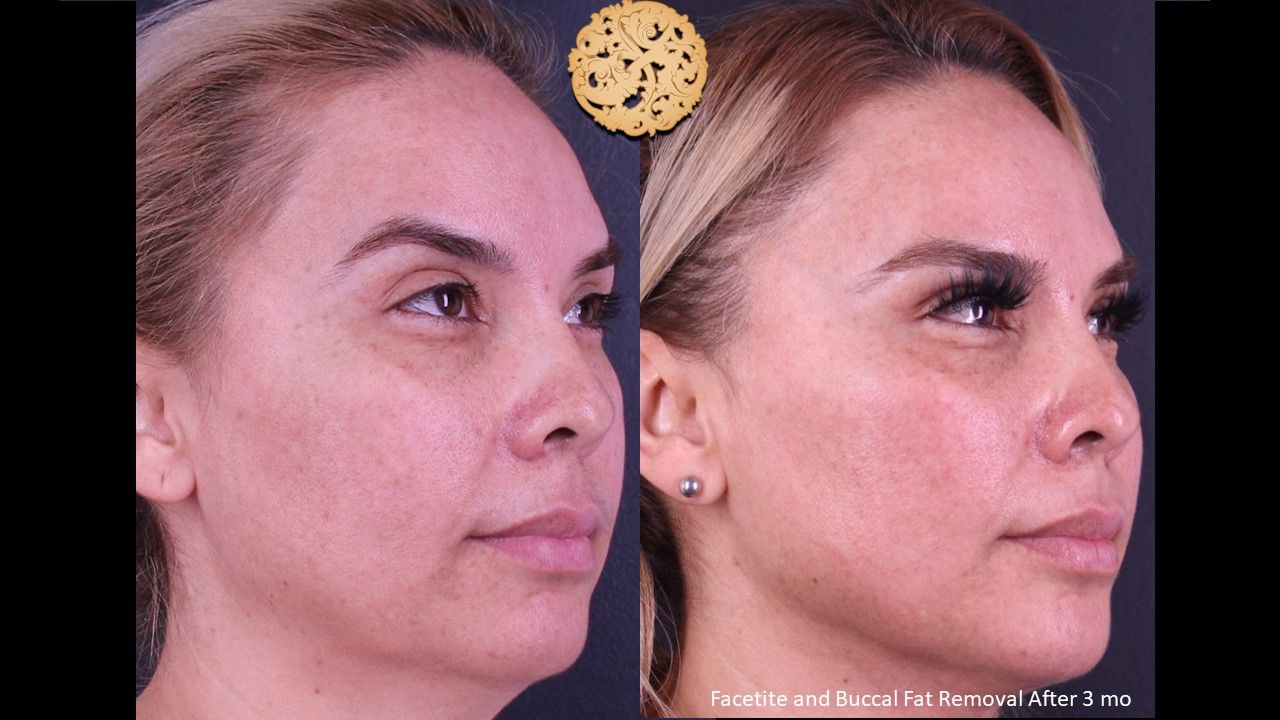 Buccal Fat Removal Before & After