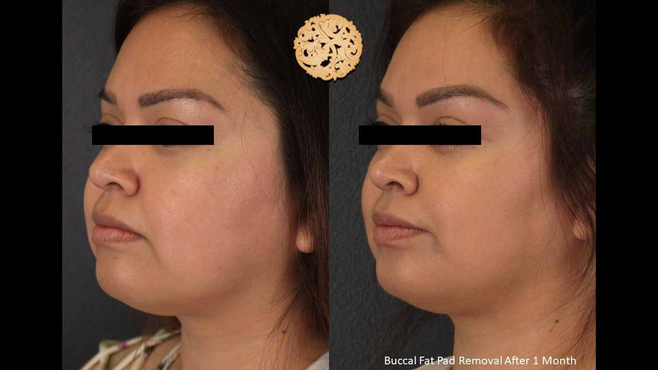 Buccal Fat Removal Before & After