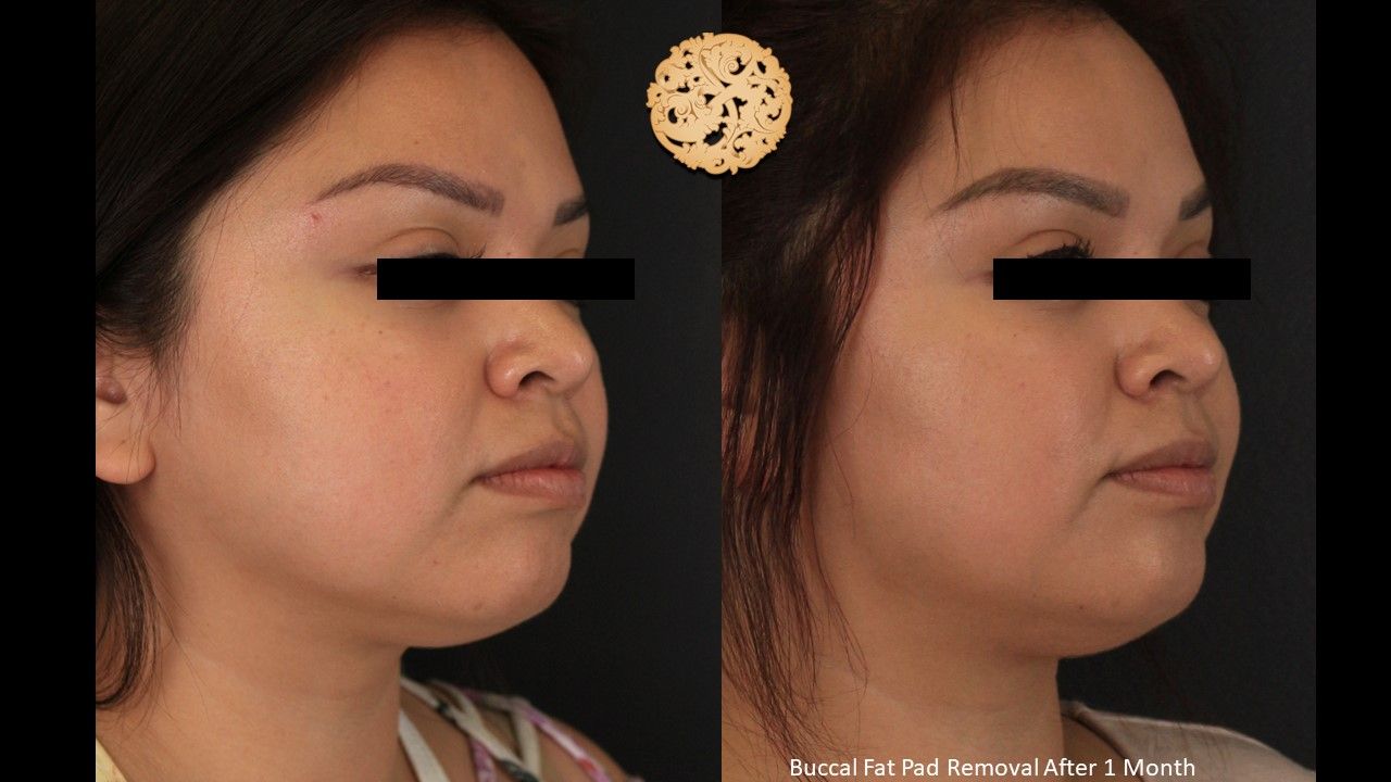 Buccal Fat Removal Before & After