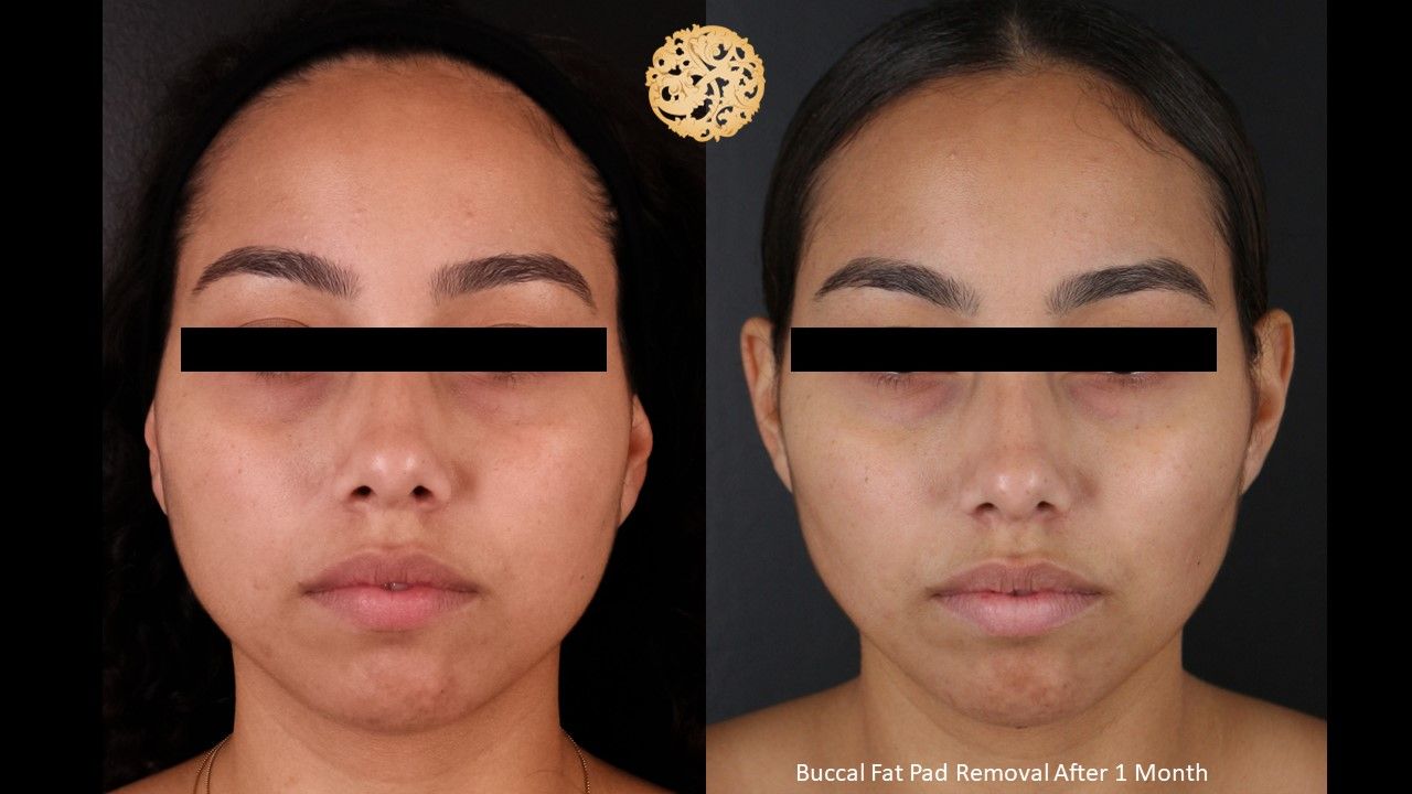 Buccal Fat Removal Before & After