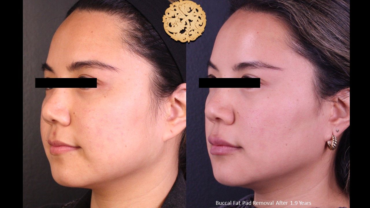 Buccal Fat Removal Before & After