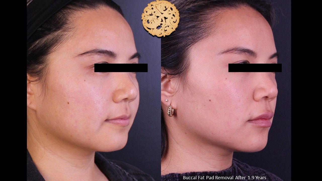 Buccal Fat Removal Before & After