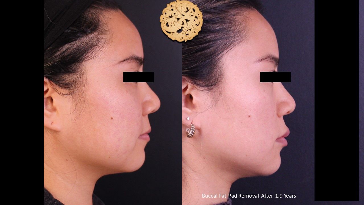 Buccal Fat Removal Before & After