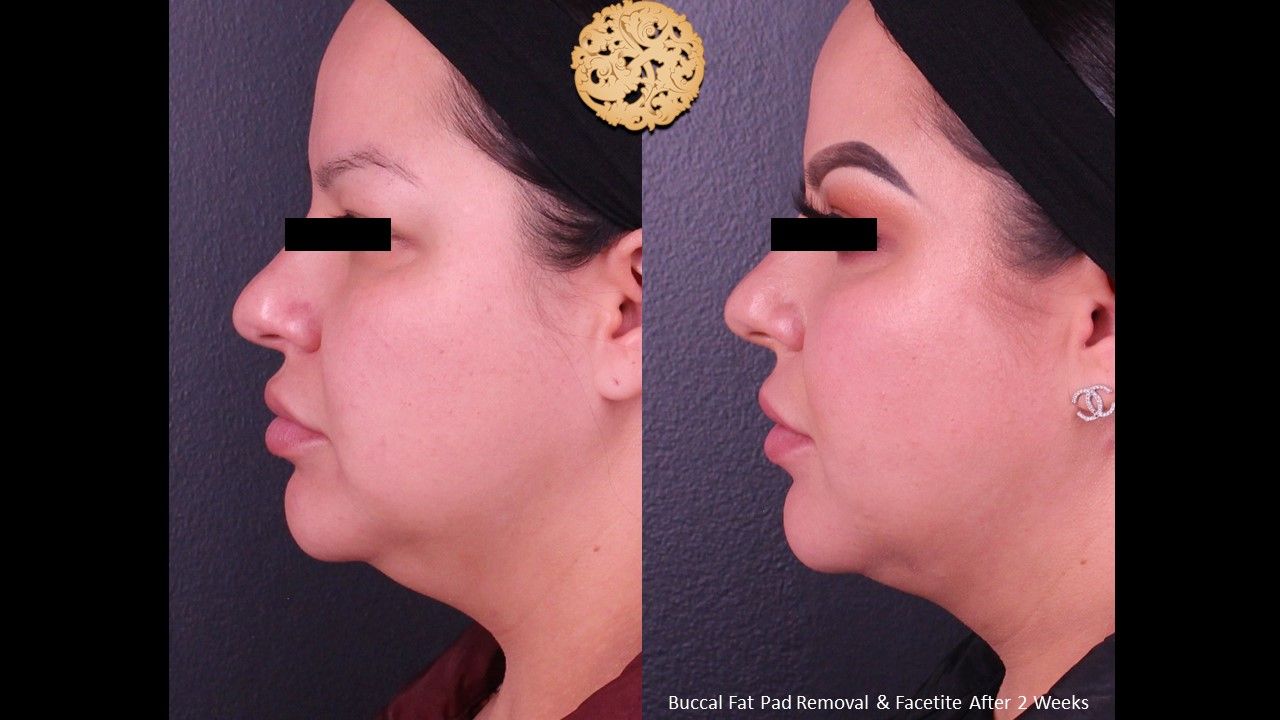 Buccal Fat Removal Before & After