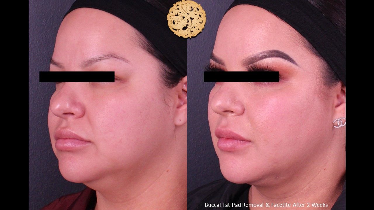 Buccal Fat Removal Before & After