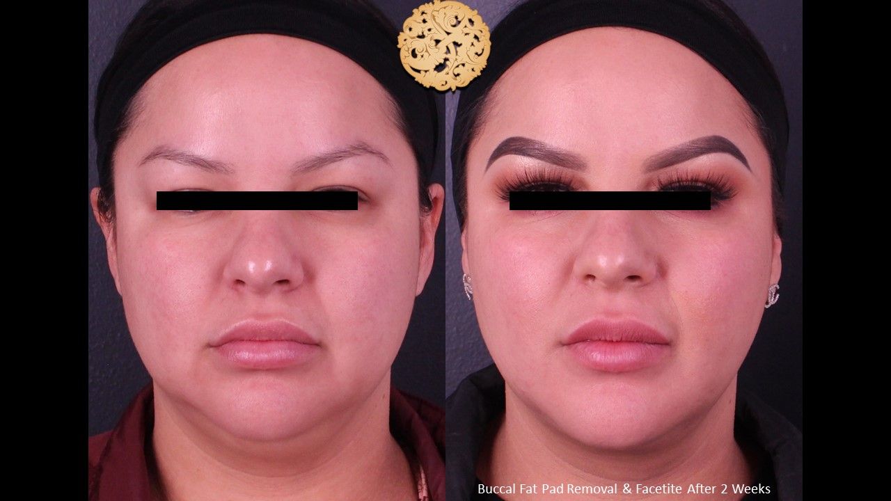 Buccal Fat Removal Before & After