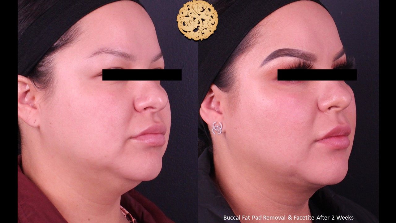 Buccal Fat Removal Before & After