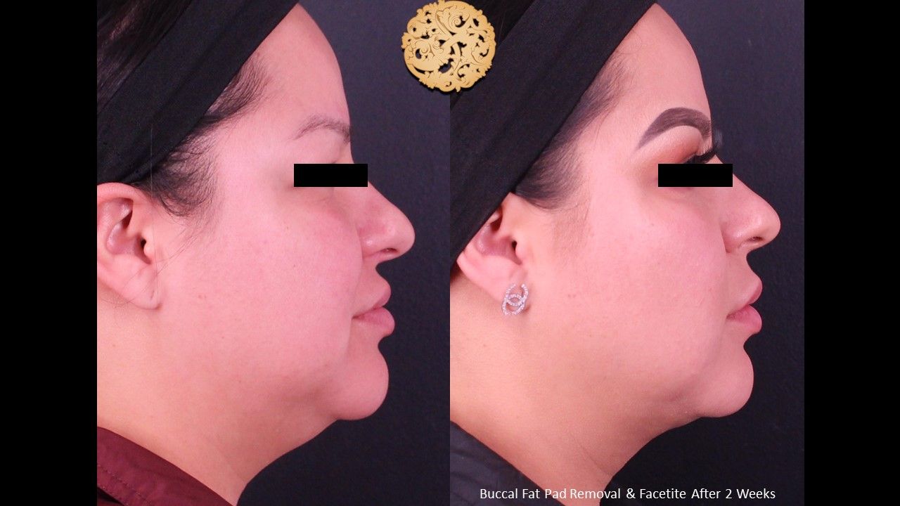 Buccal Fat Removal Before & After