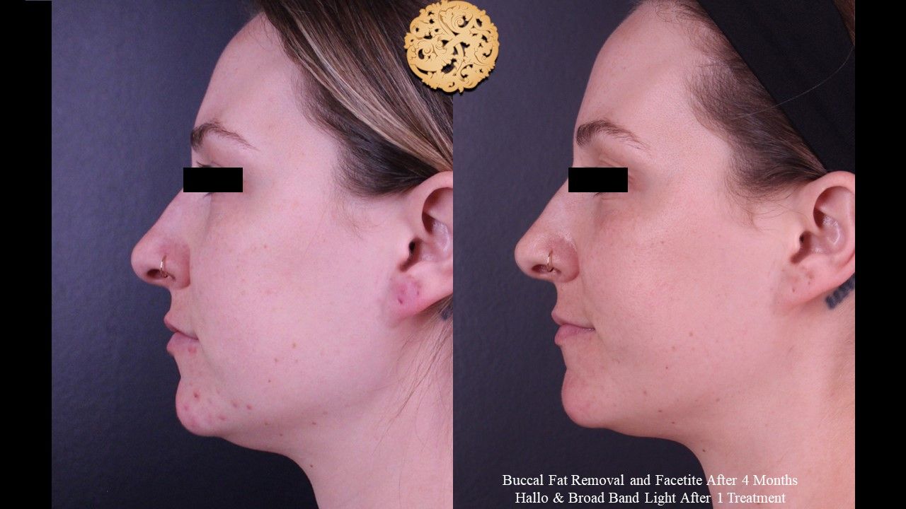 Buccal Fat Removal Before & After