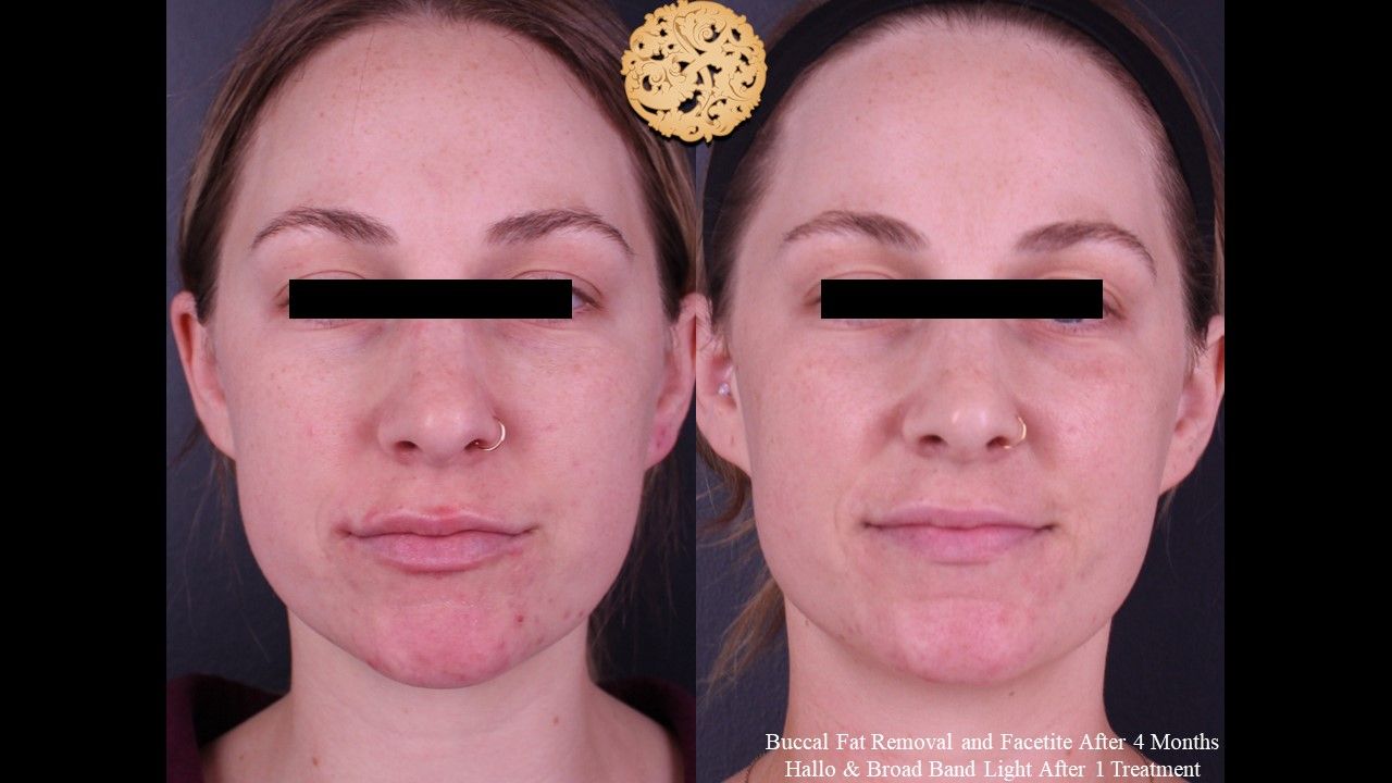 Buccal Fat Removal Before & After