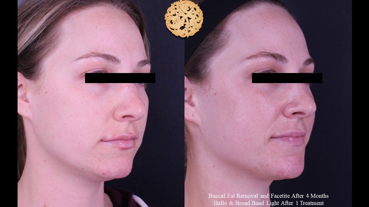 Buccal Fat Removal Before & After