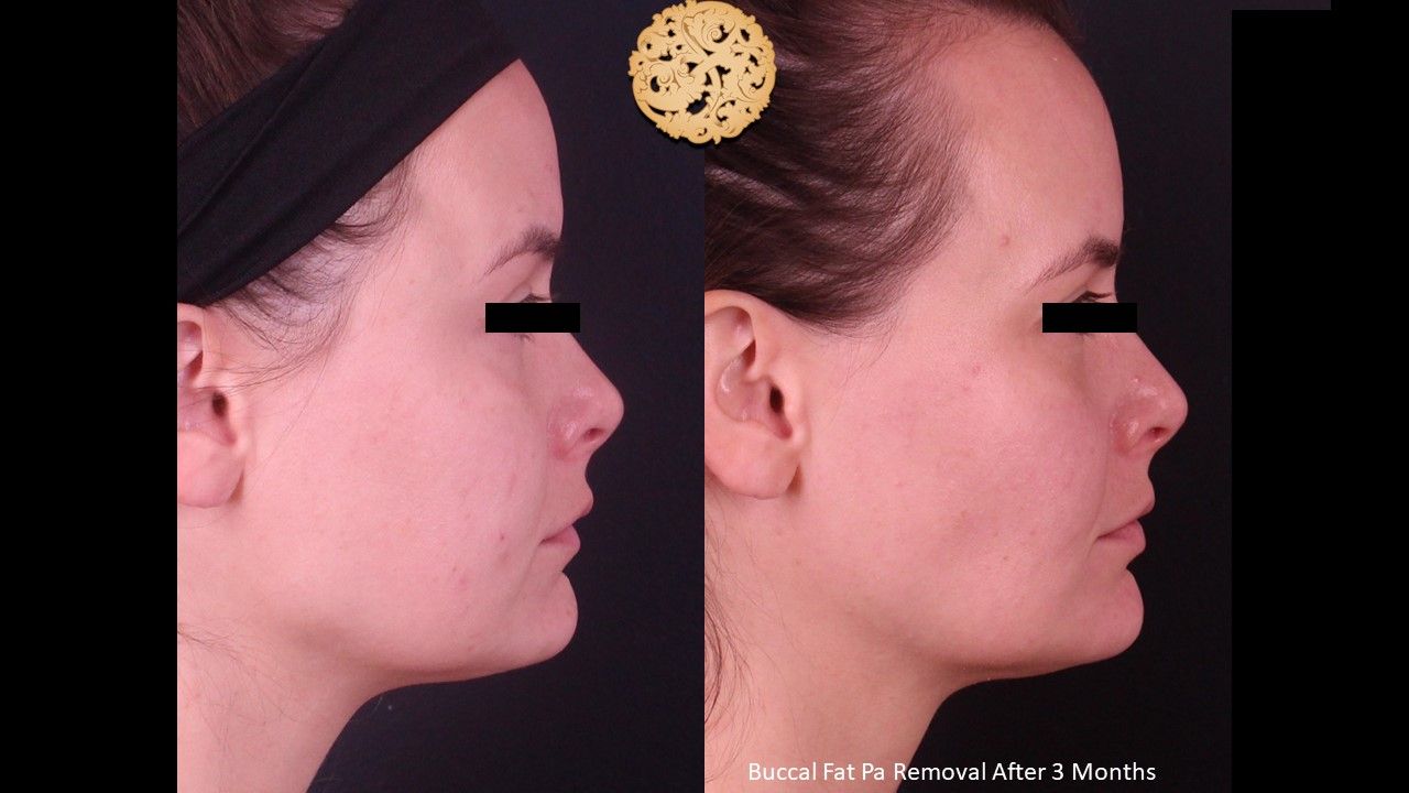Buccal Fat Removal Before & After