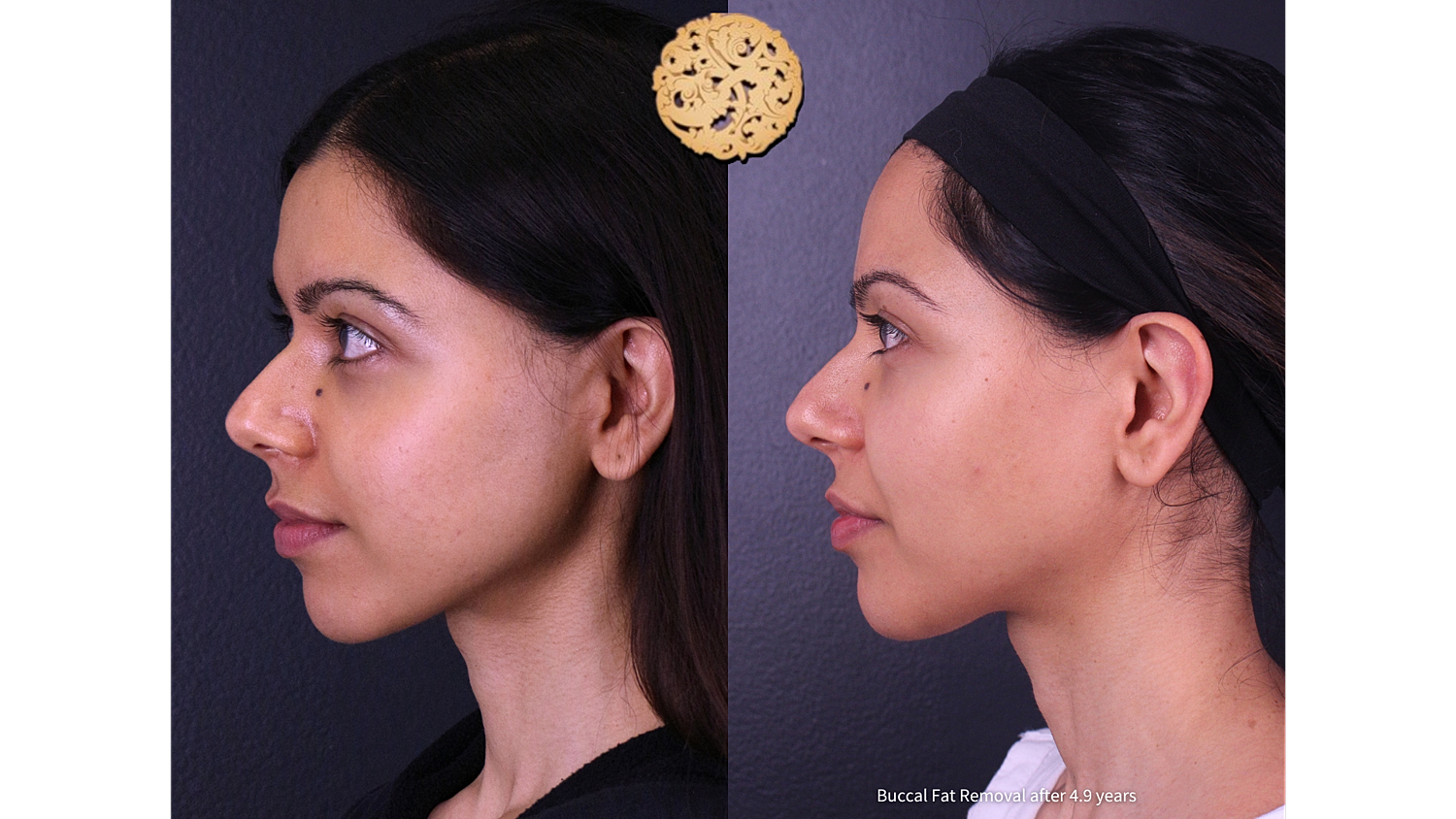 Buccal Fat Removal After 4.9 Years