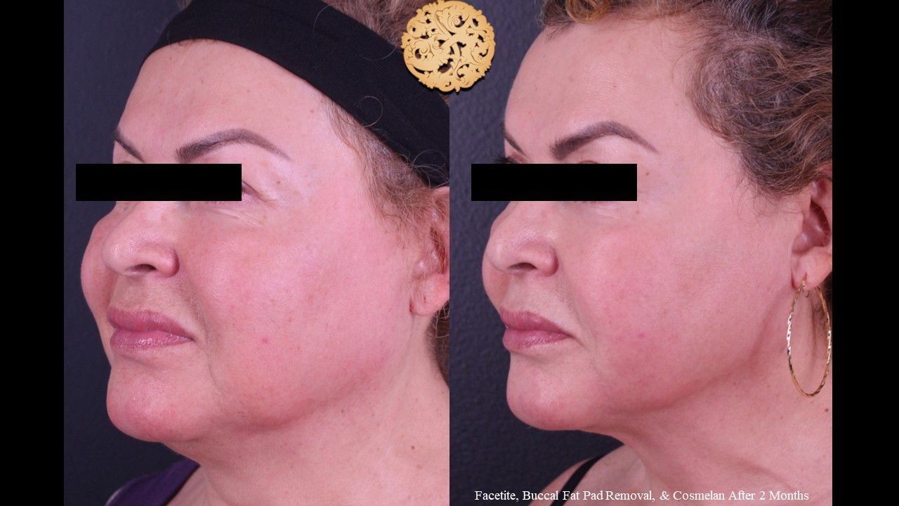 Buccal Fat Removal Before & After