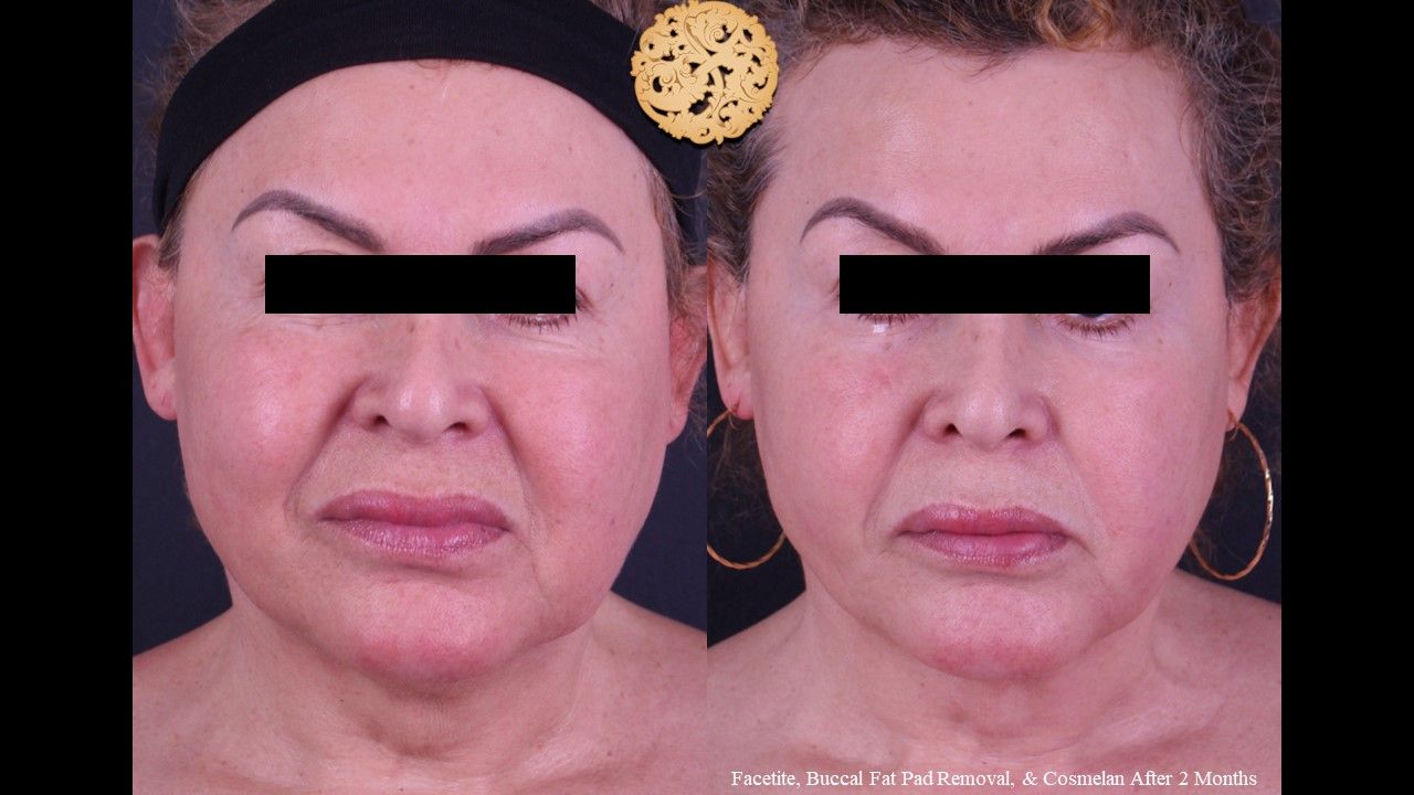 Buccal Fat Removal Before & After