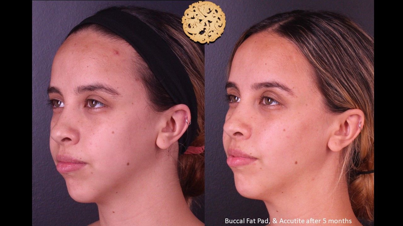 Buccal Fat Removal Before & After