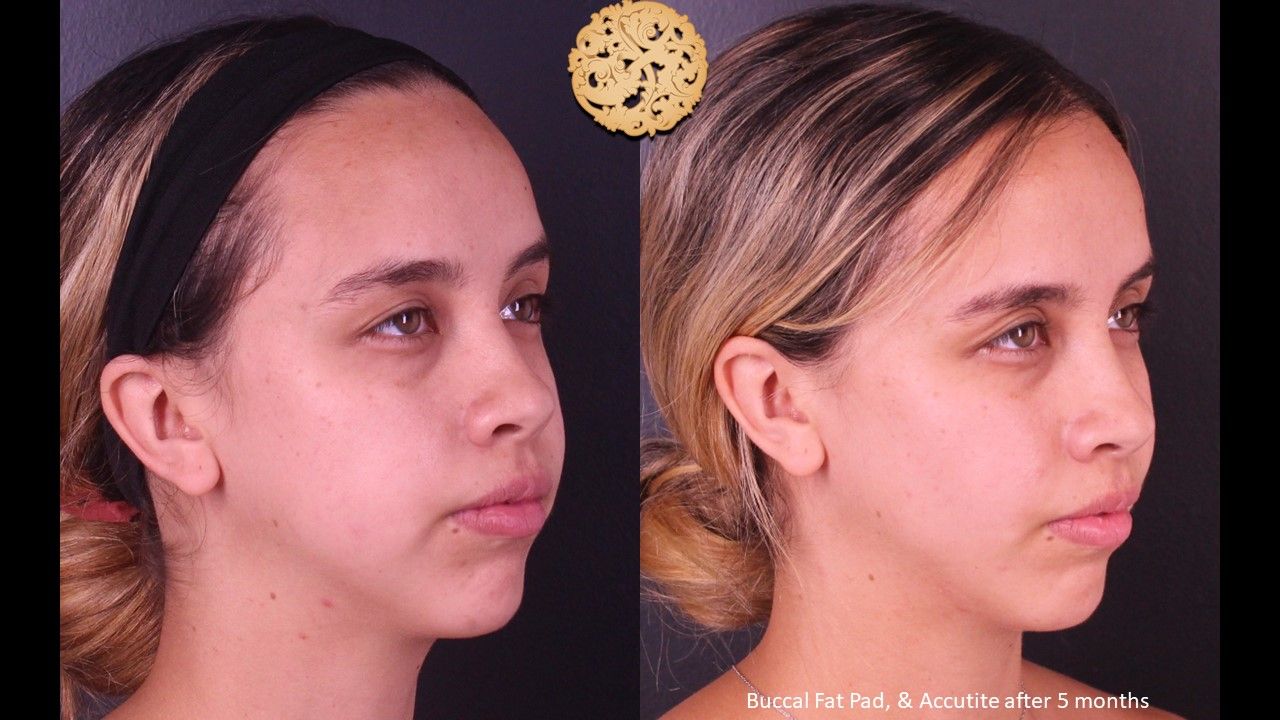Buccal Fat Removal Before & After