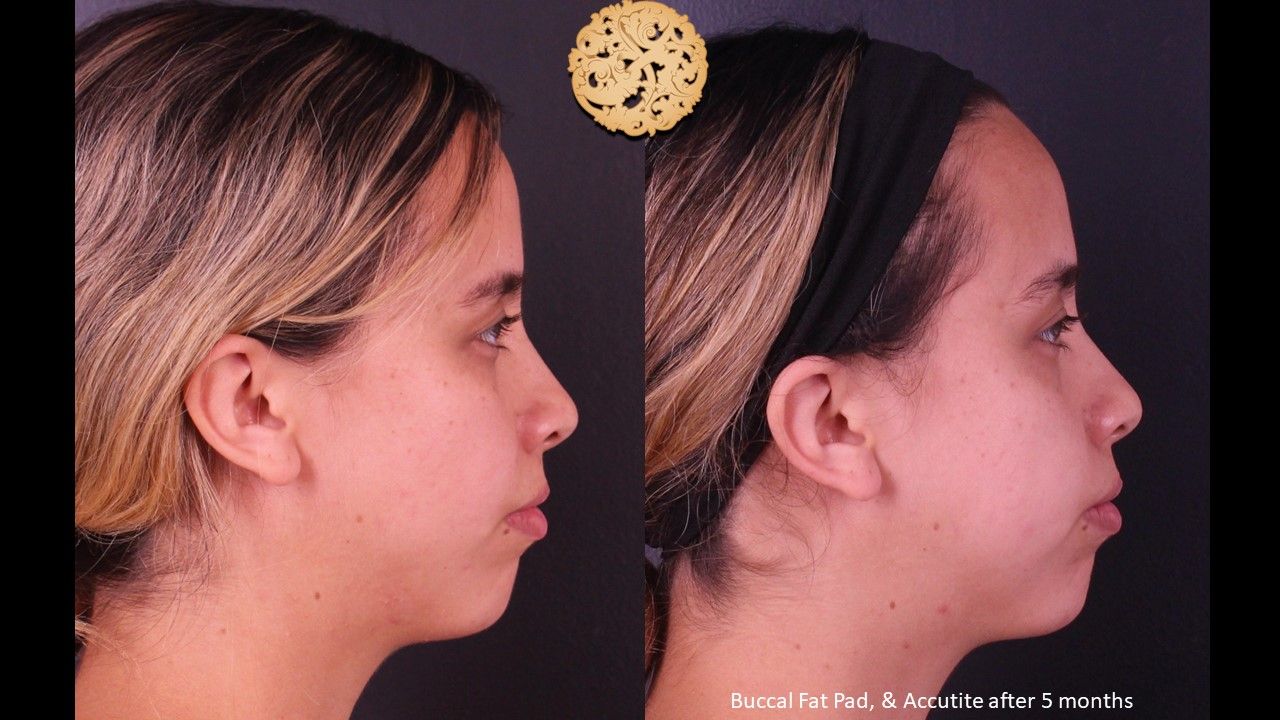 Buccal Fat Removal Before & After