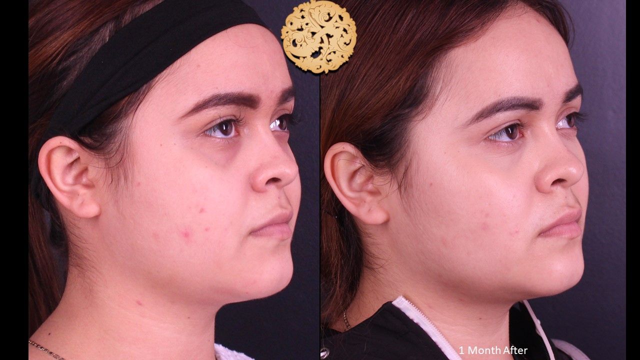 Buccal Fat Removal Before & After