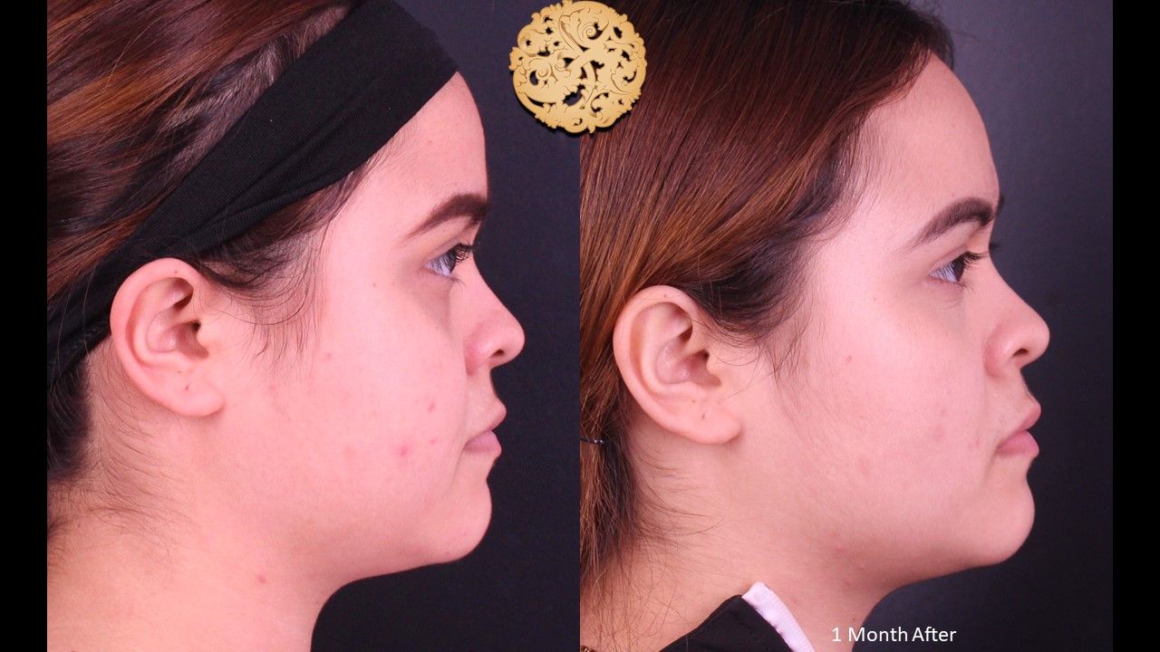 Buccal Fat Removal Before & After