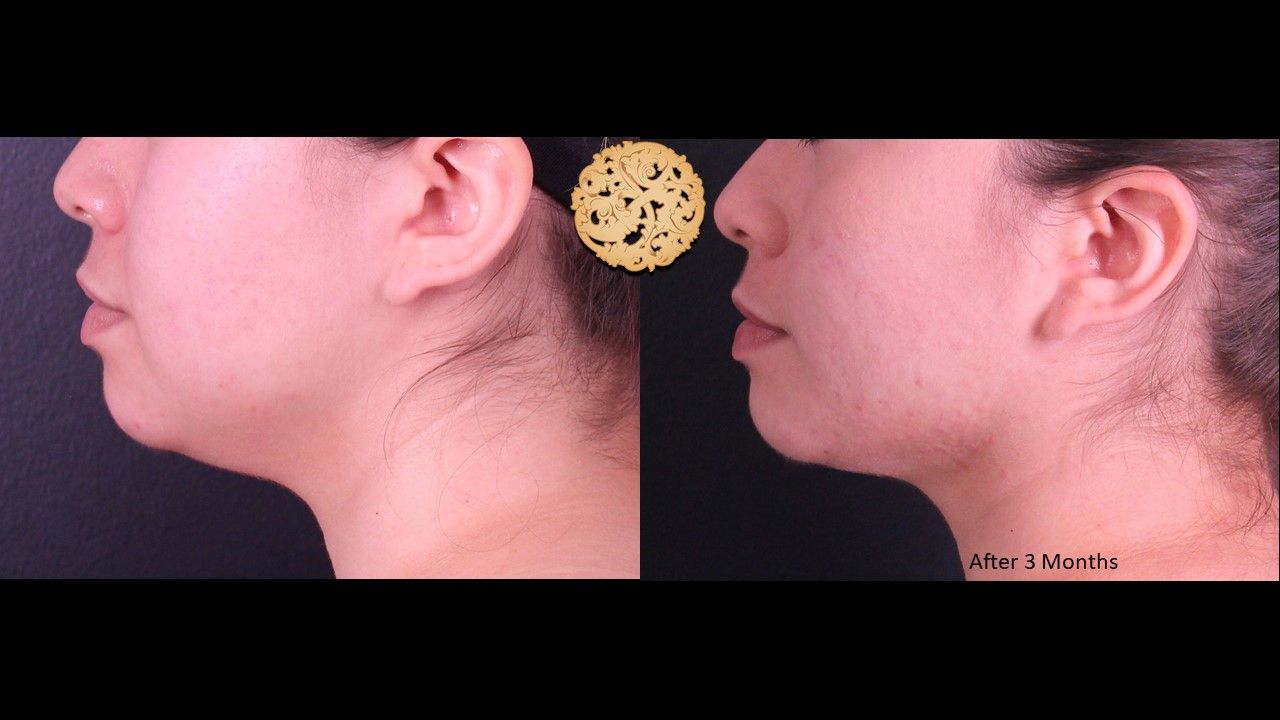 Buccal Fat Removal Before & After