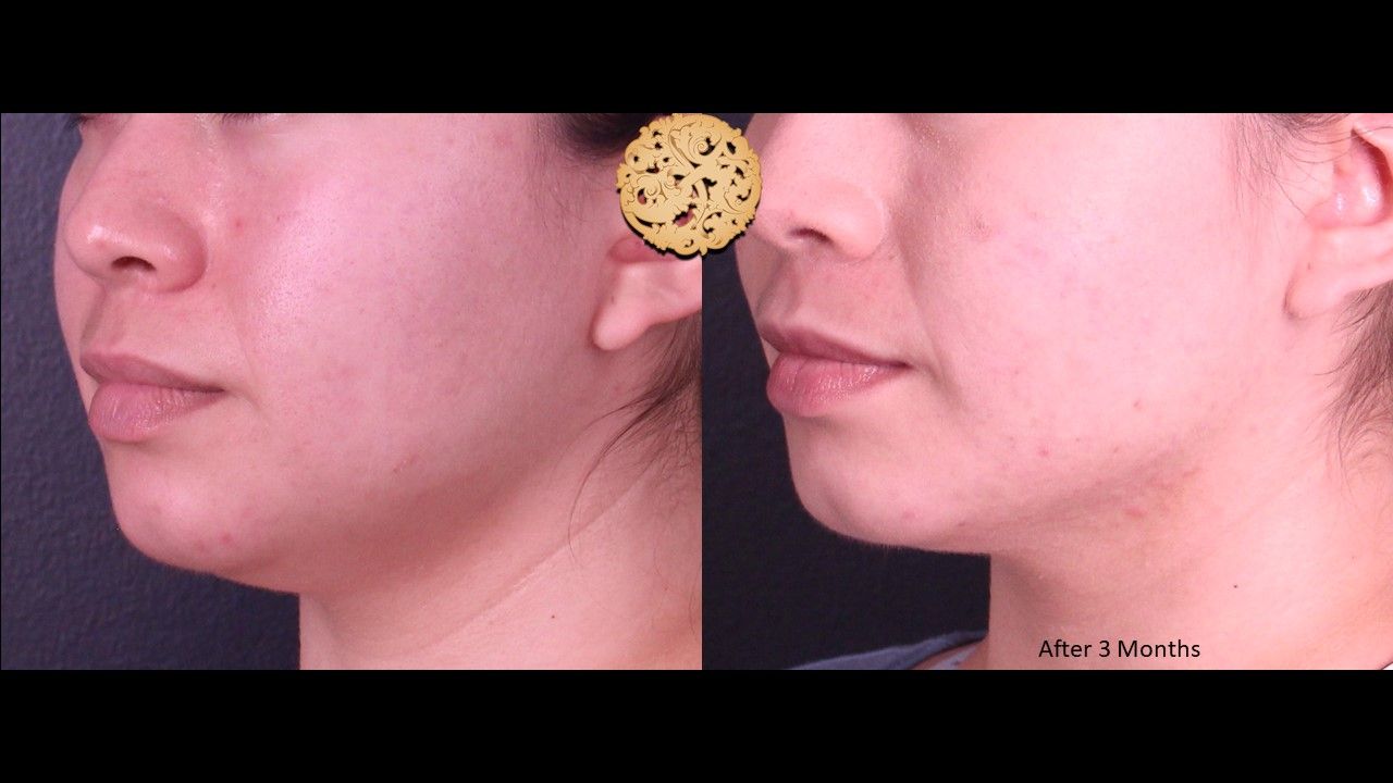 Buccal Fat Removal Before & After