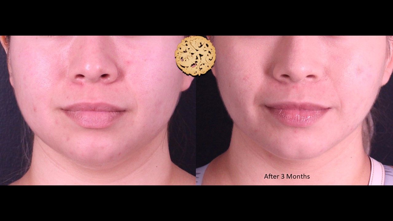 Buccal Fat Removal Before & After
