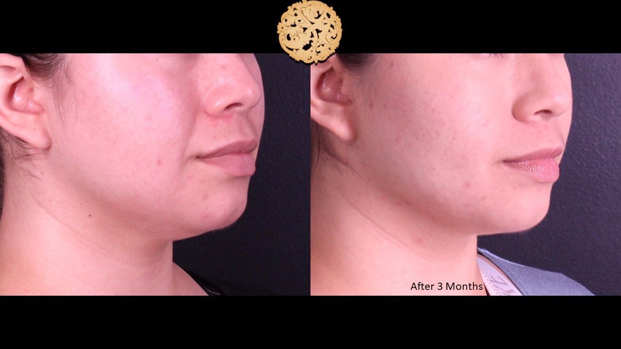 Buccal Fat Removal Before & After