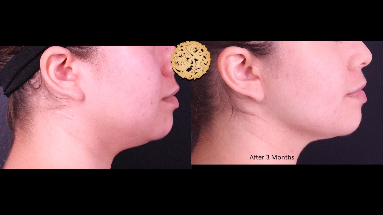 Buccal Fat Removal Before & After