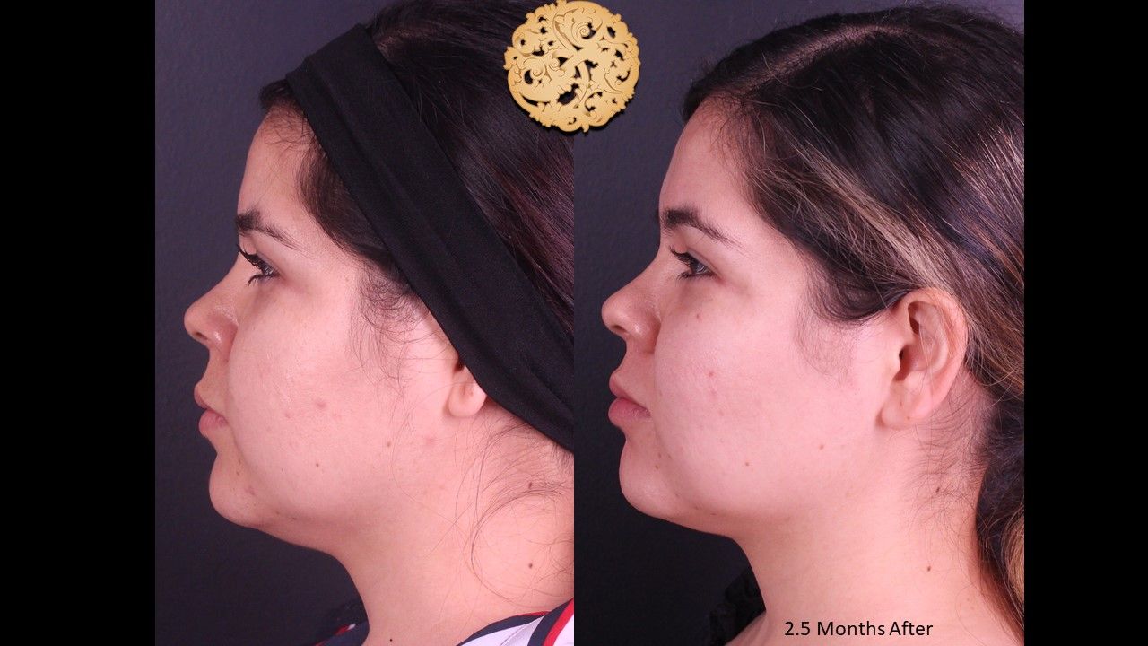 Buccal Fat Removal Before & After