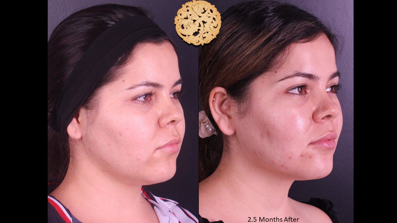 Buccal Fat Removal Before & After