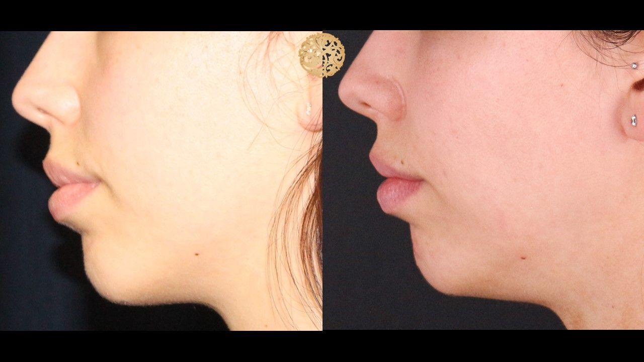 Buccal Fat Removal Before & After