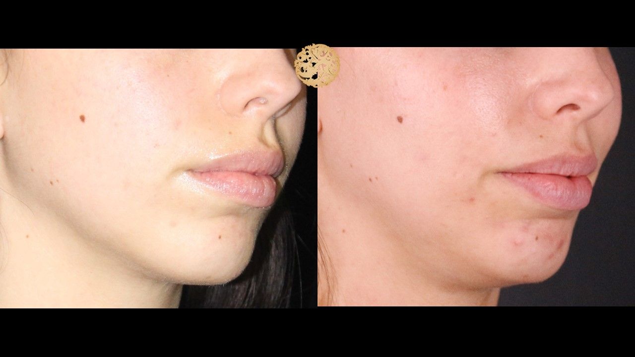 Buccal Fat Removal Before & After