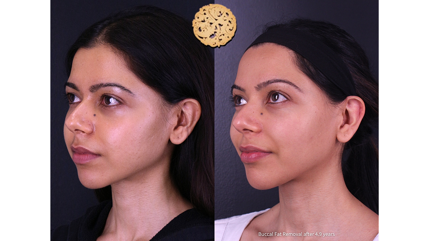 Buccal Fat Removal After 4.9 Years