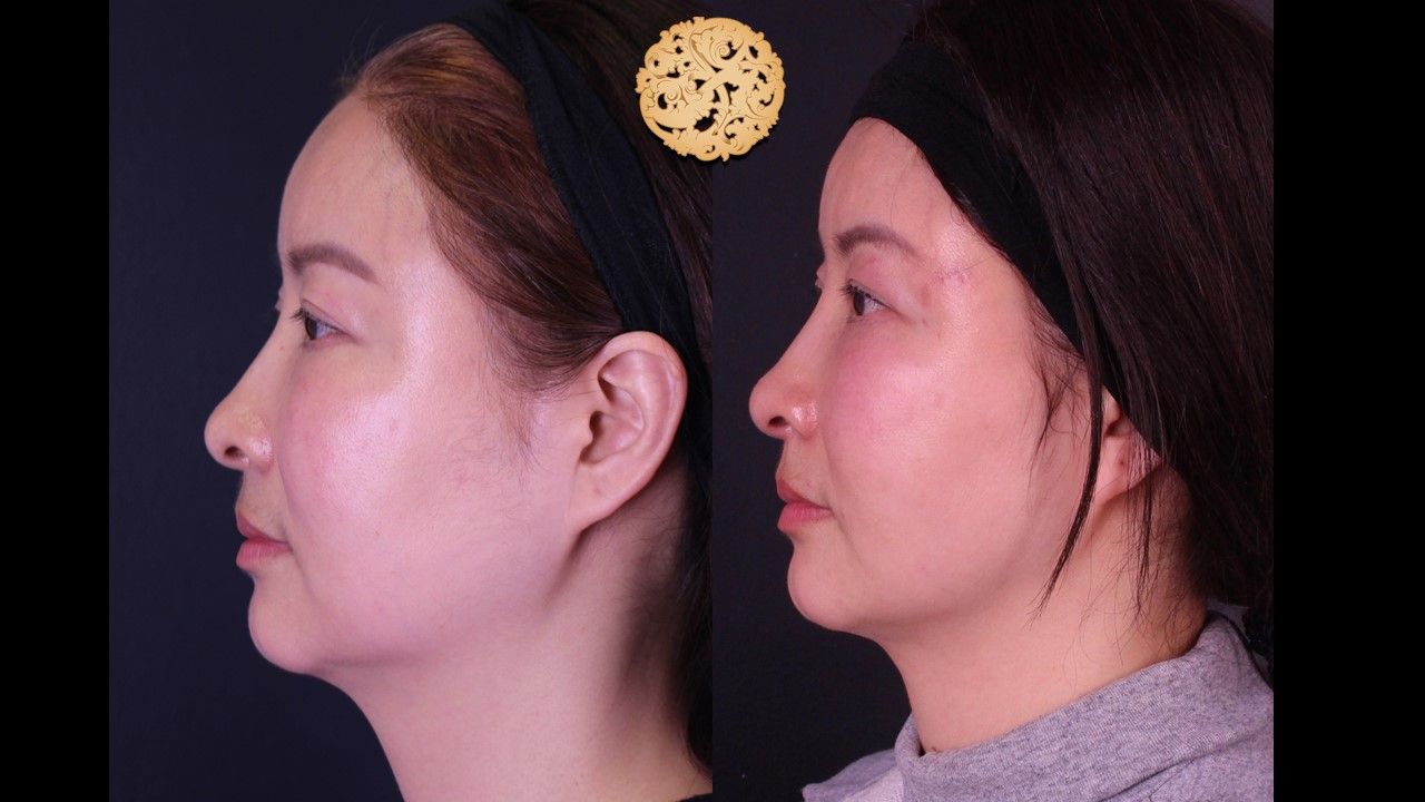 Buccal Fat Removal Before & After