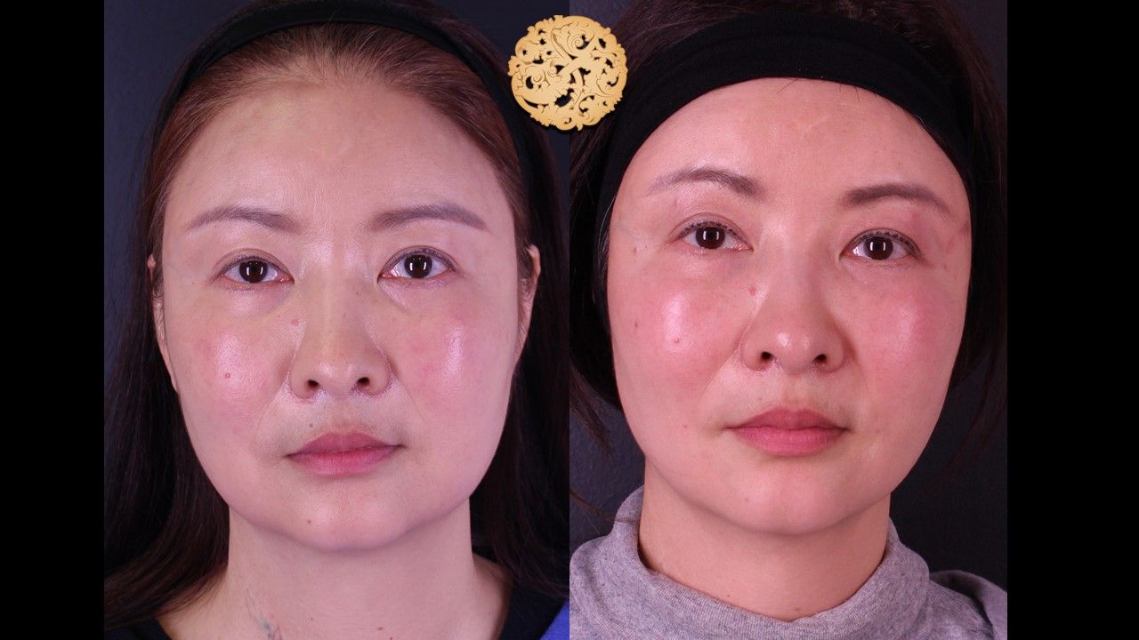 Buccal Fat Removal Before & After