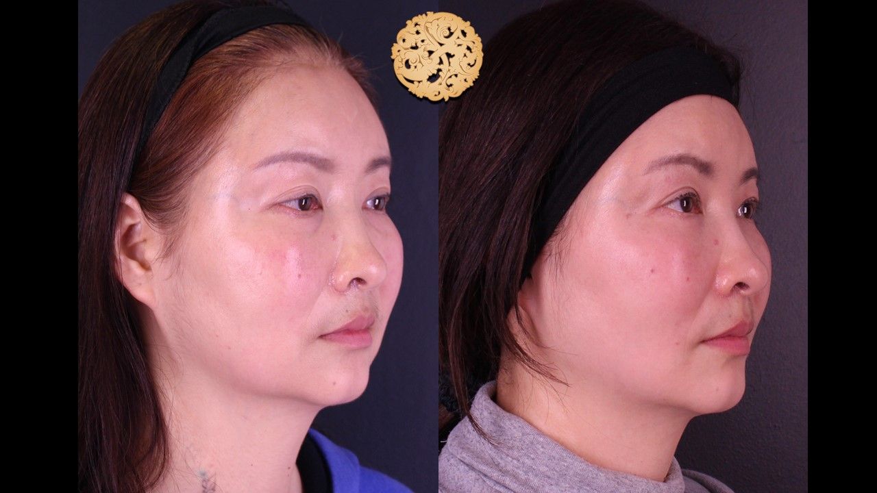 Buccal Fat Removal Before & After
