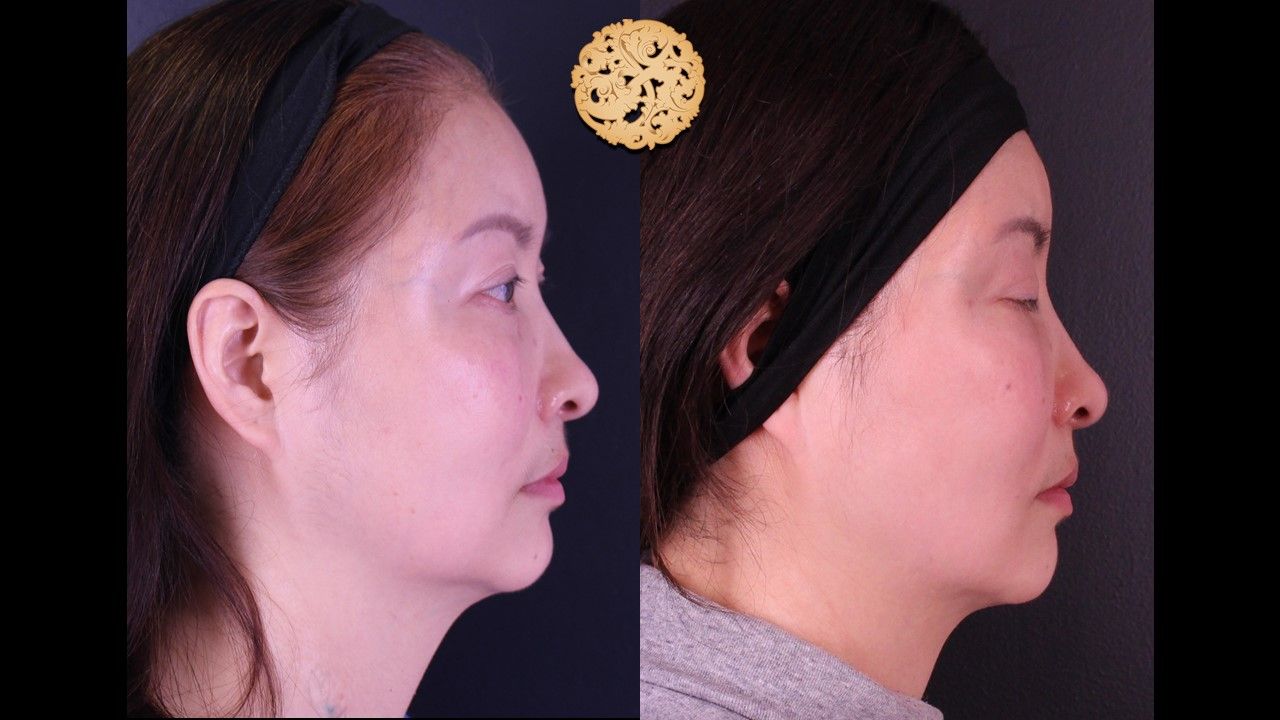 Buccal Fat Removal Before & After