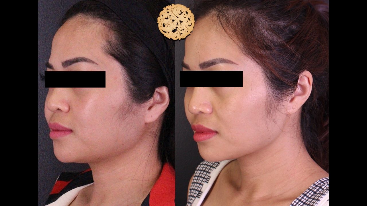 Buccal Fat Removal Before & After