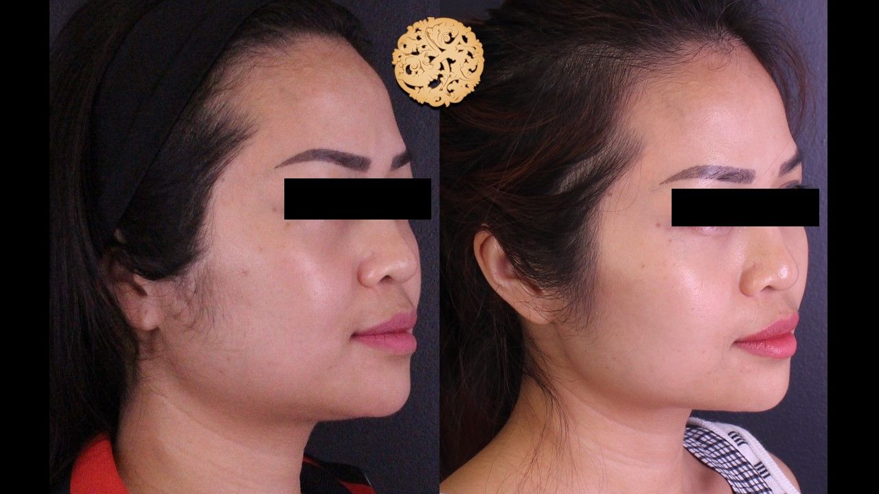 Buccal Fat Removal Before & After