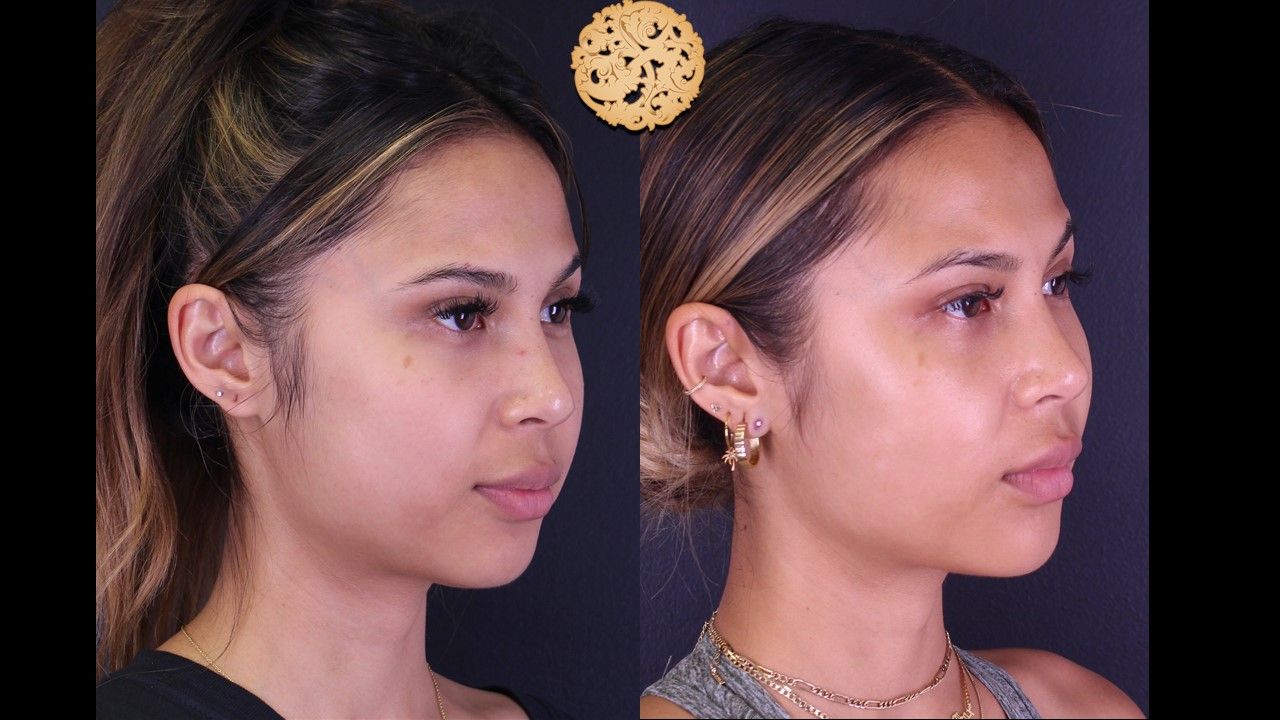 Buccal Fat Removal Before & After