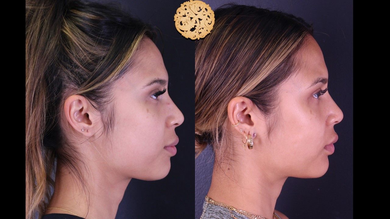Buccal Fat Removal Before & After