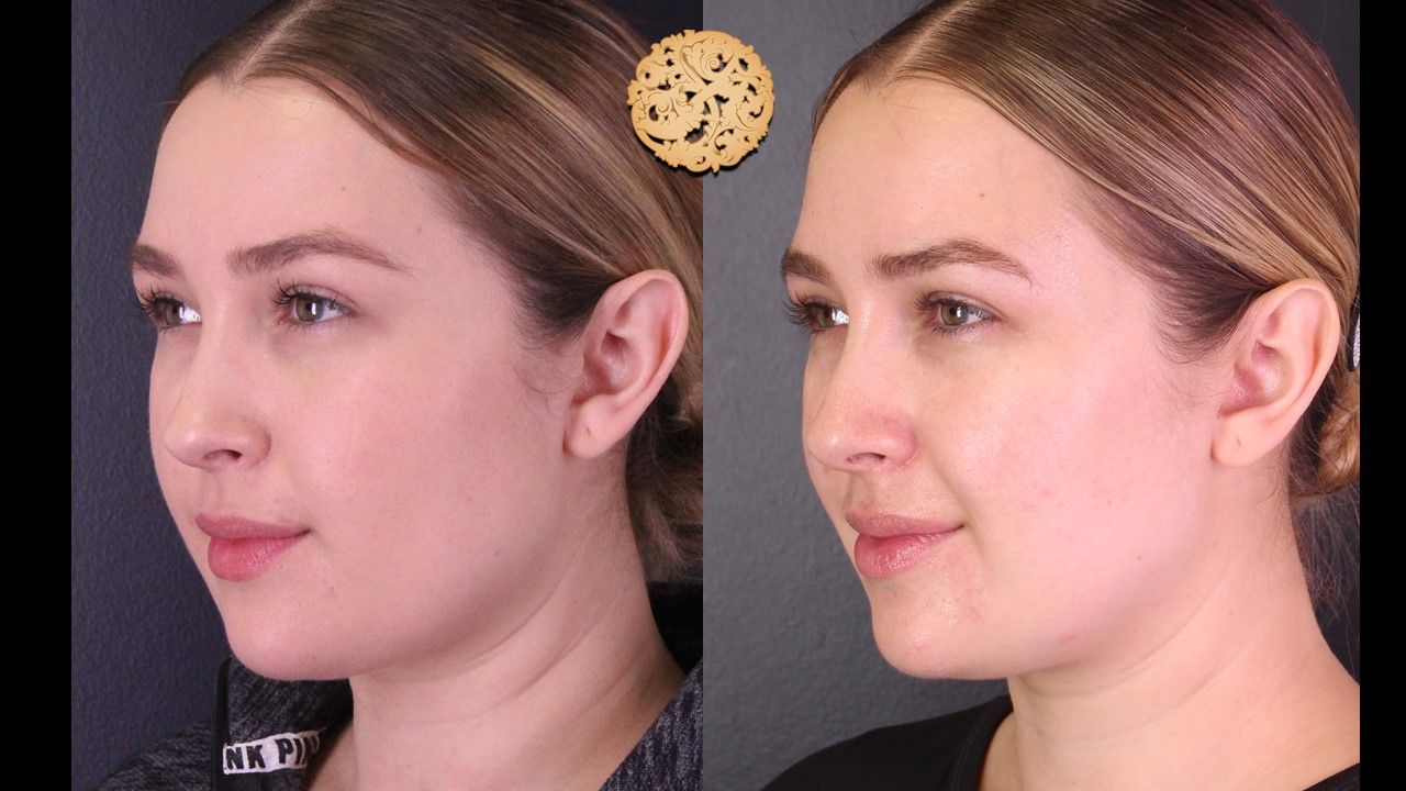 Buccal Fat Removal Before & After