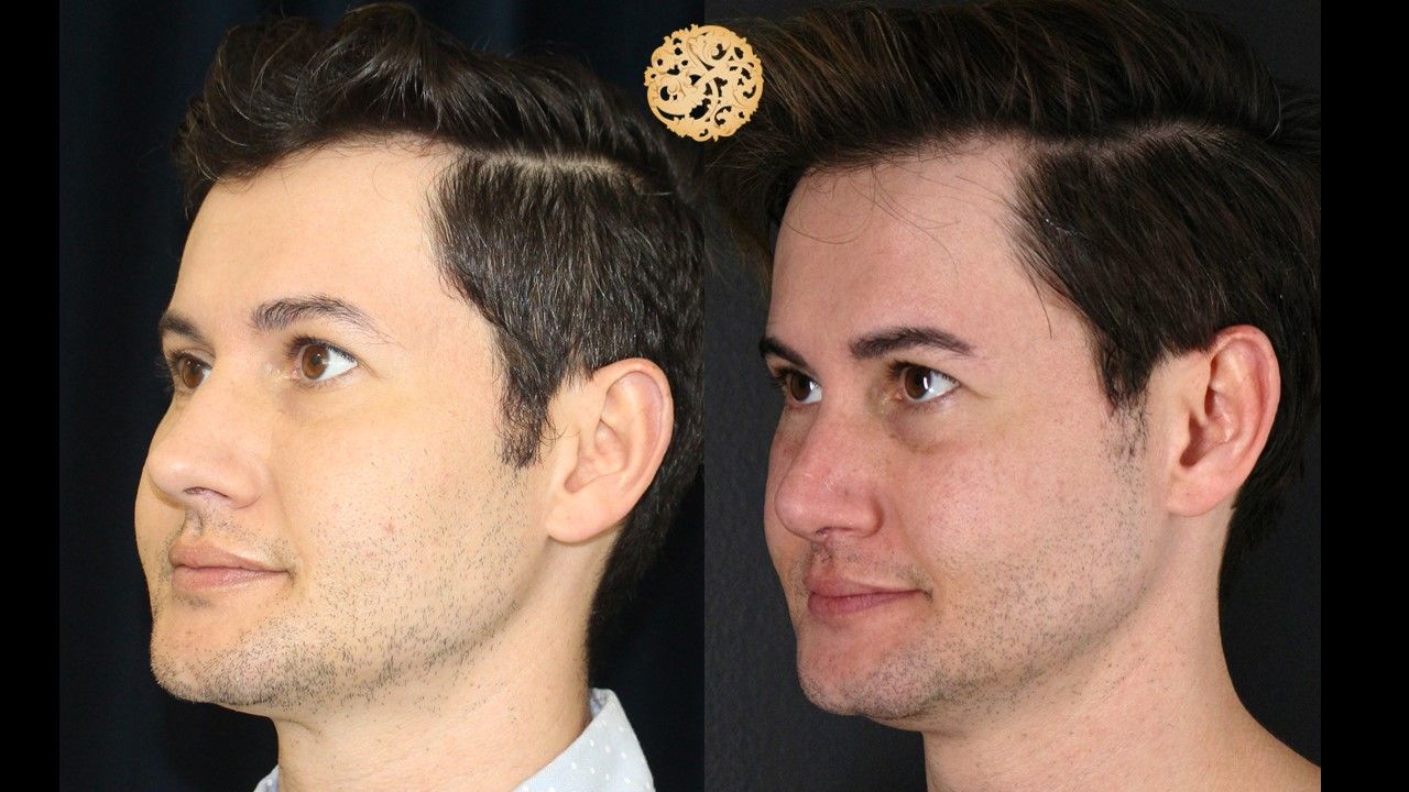 Buccal Fat Removal Before & After