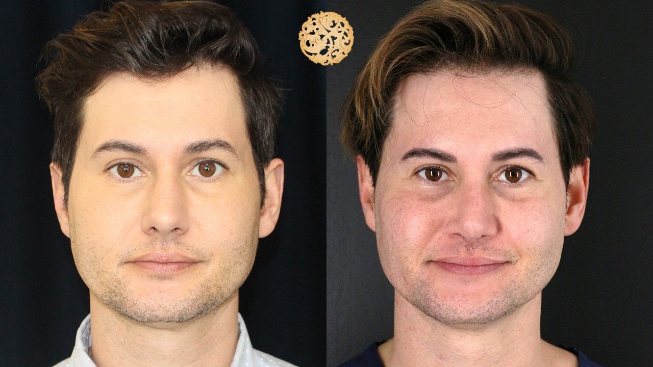 Buccal Fat Removal Before & After