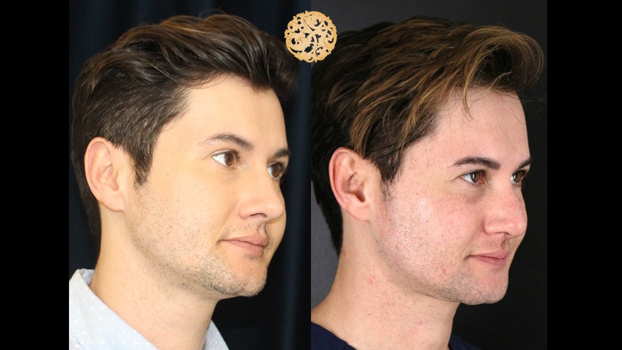 Buccal Fat Removal Before & After