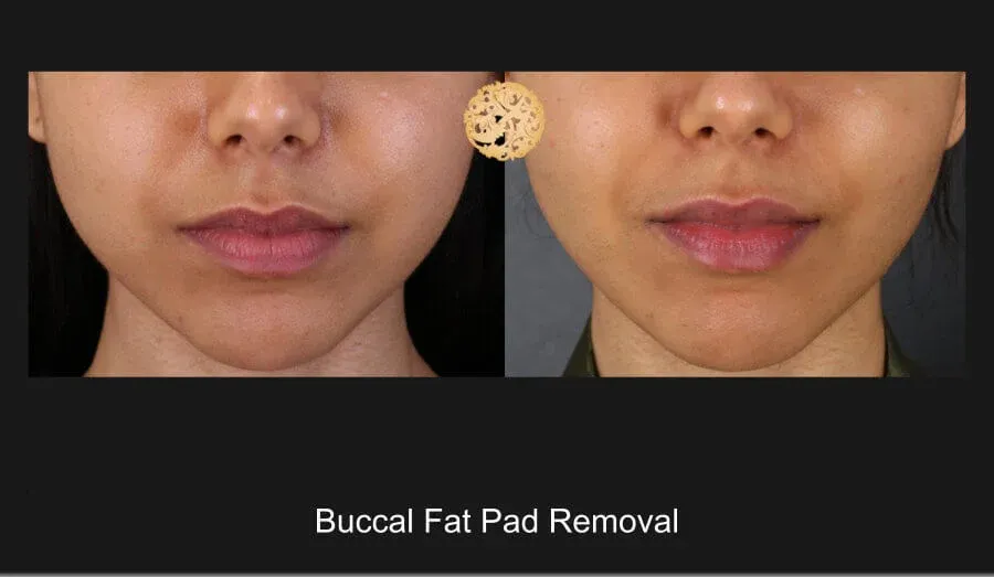 Buccal Fat Removal Before & After