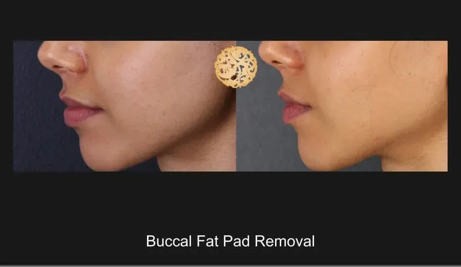 Buccal Fat Removal Before & After