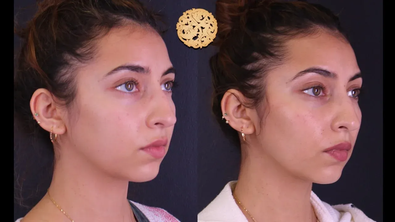 Buccal Fat Removal Before & After